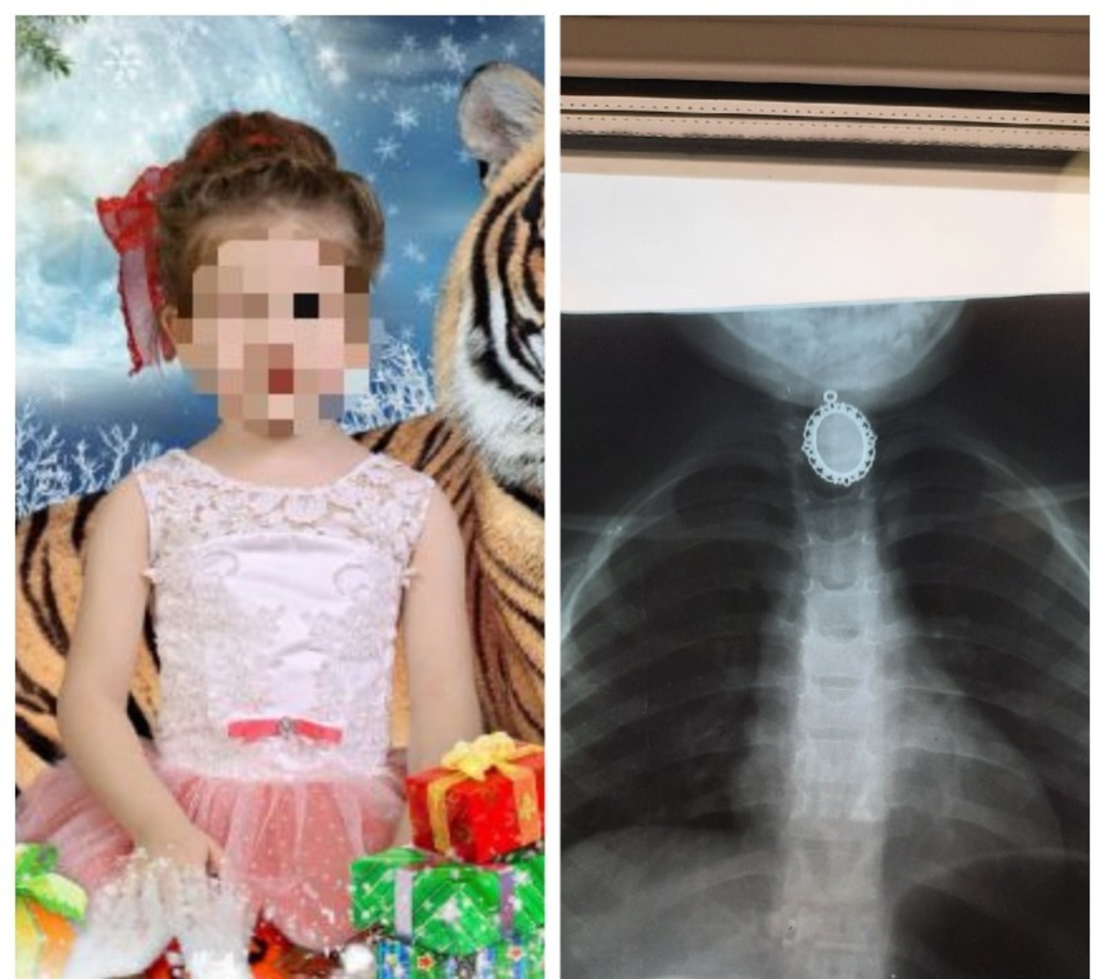 В Кумертау 4-летняя девочка проглотила подвеску, инородный предмет застрял в трахее
