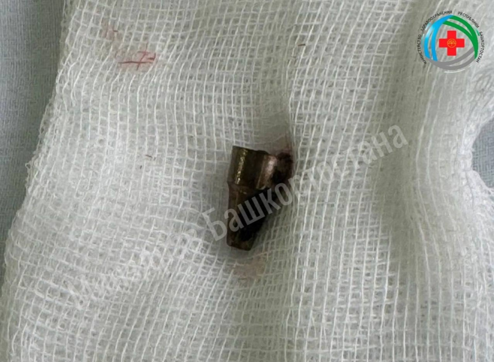 В Башкирии хирурги  достали из уха пациентки наконечник ручки