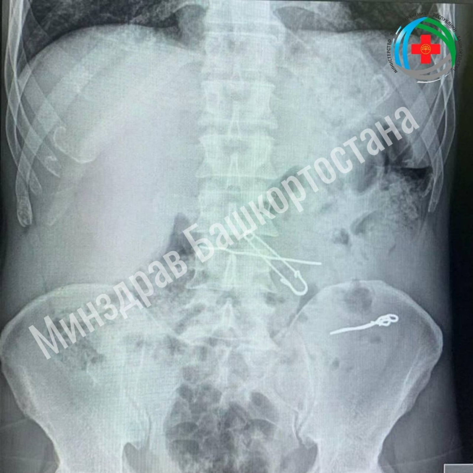 Мужчина из Башкирии проглотил ключи, скрепки, булавку и проволоку