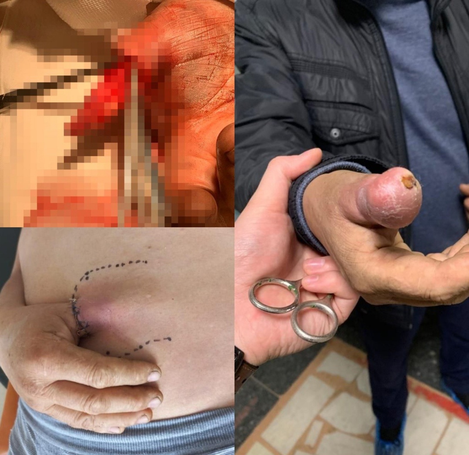 В Башкирии травматологи провели редкую операцию: изувеченный палец восстановили через брюшную стенку