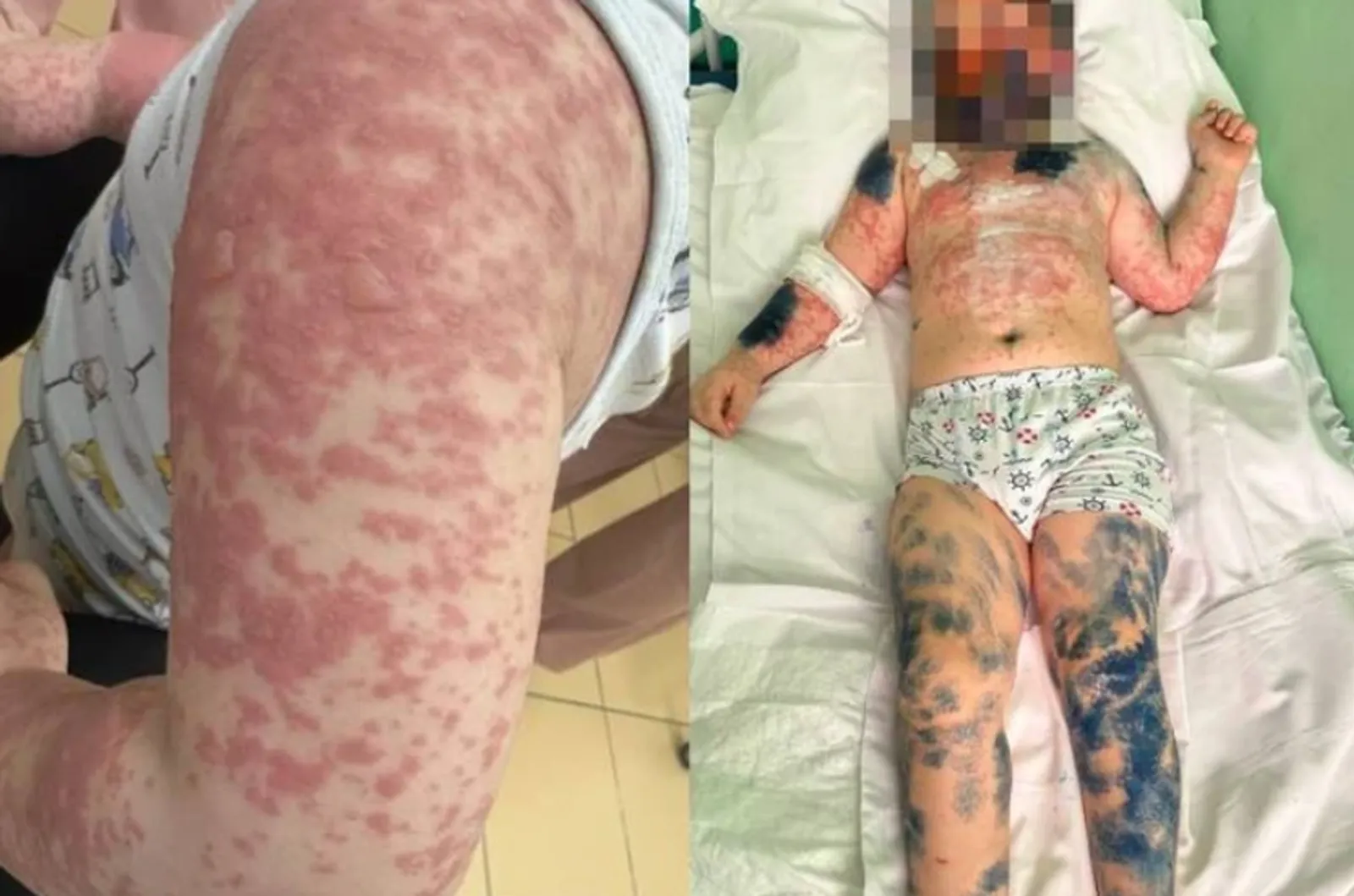 В Башкирии врачи спасли ребенка с синдромом «ошпаренной кожи»