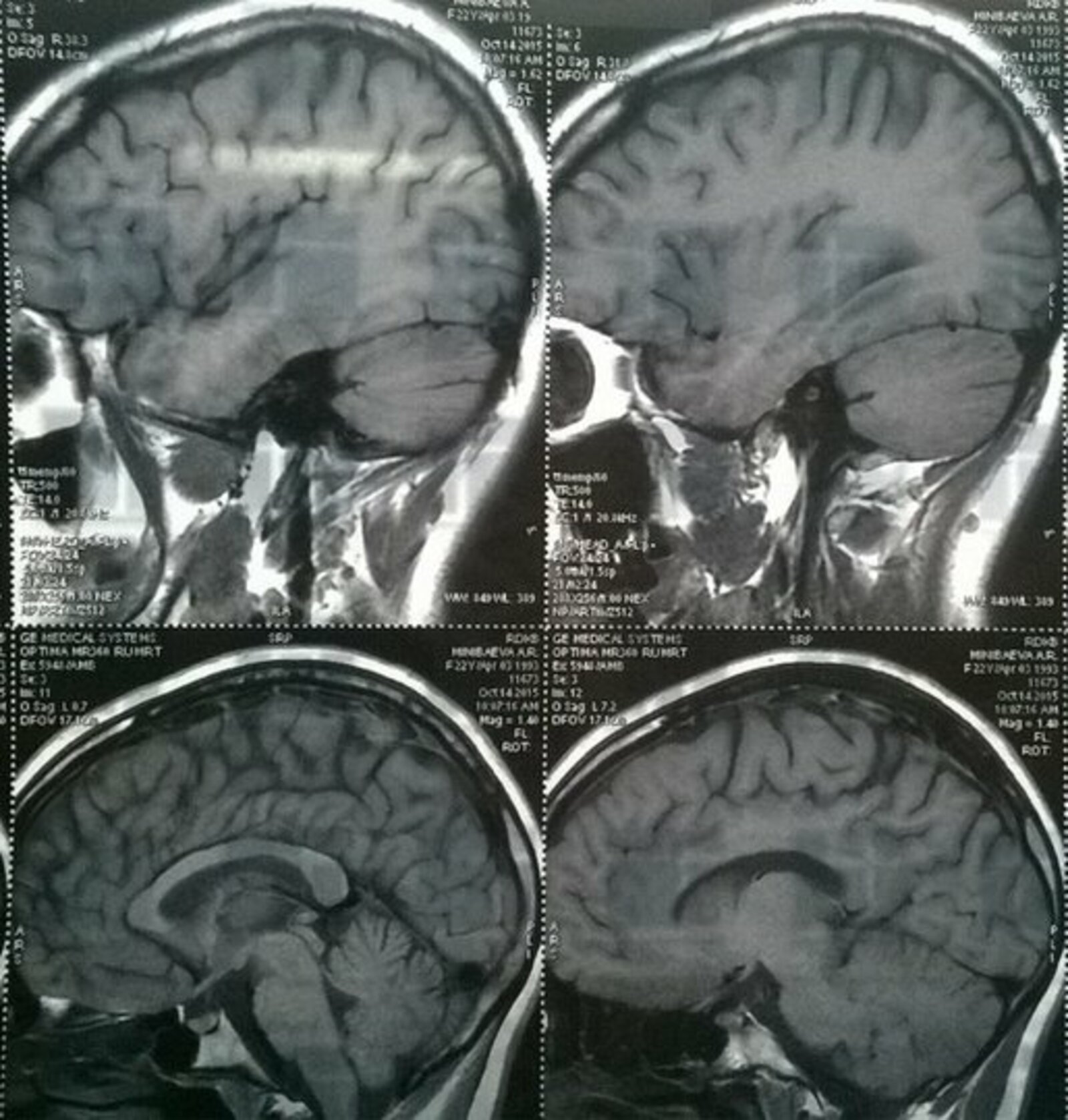 В Башкирии у пятерых жителей обнаружили болезнь, поражающую мозг