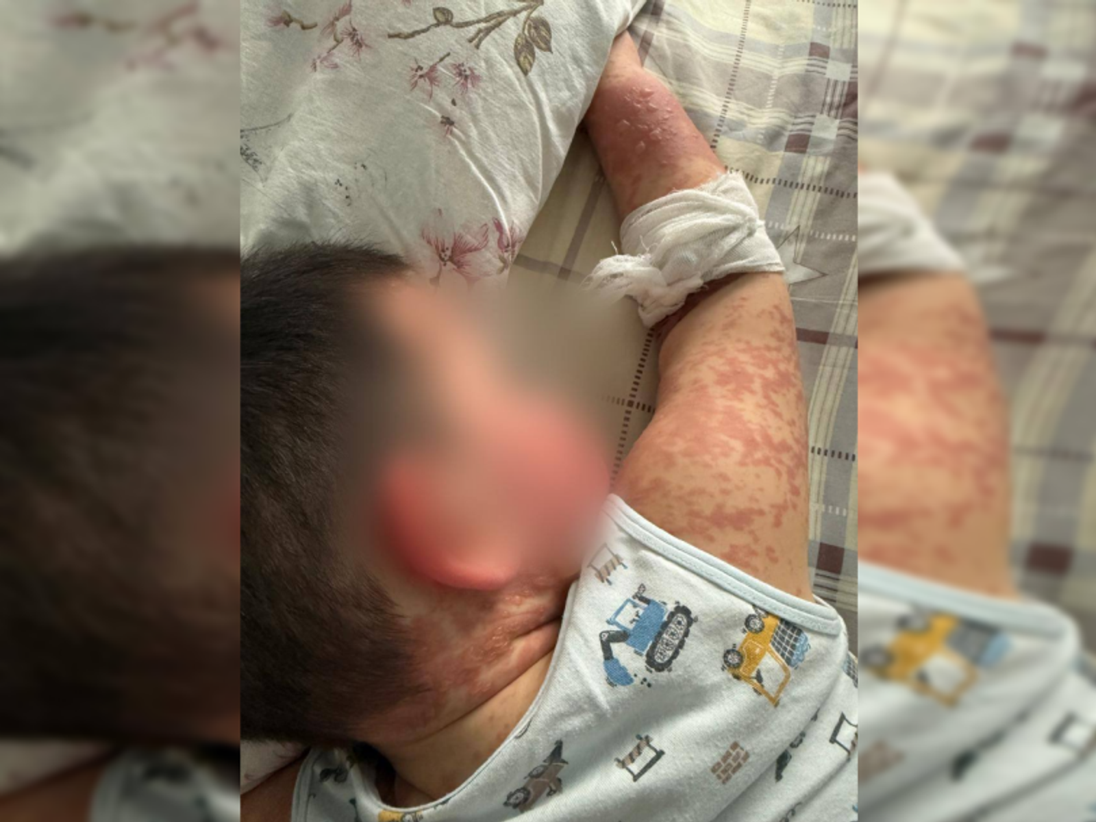 В Башкирии врачи спасли жизнь ребенку с синдромом «ошпаренной кожи»